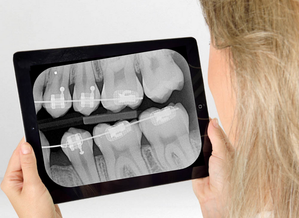 Radiografía Retroalveolar BiteWing